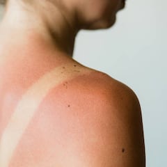 ¿Qué es el ‘callo solar’? La peligrosa tendencia viral que Sanidad y la OCU ha desmentido