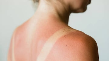 ¿Qué es el ‘callo solar’? La peligrosa tendencia viral que Sanidad y la OCU ha desmentido