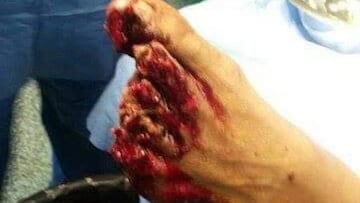 Así quedó el pie de Toranzo