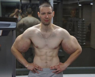 Es conocido mundialmente por sus grandes y deformes bceps. Est de actualidad tras inyectarse aceite para una pelea MMA, que perdi en el primer asalto.