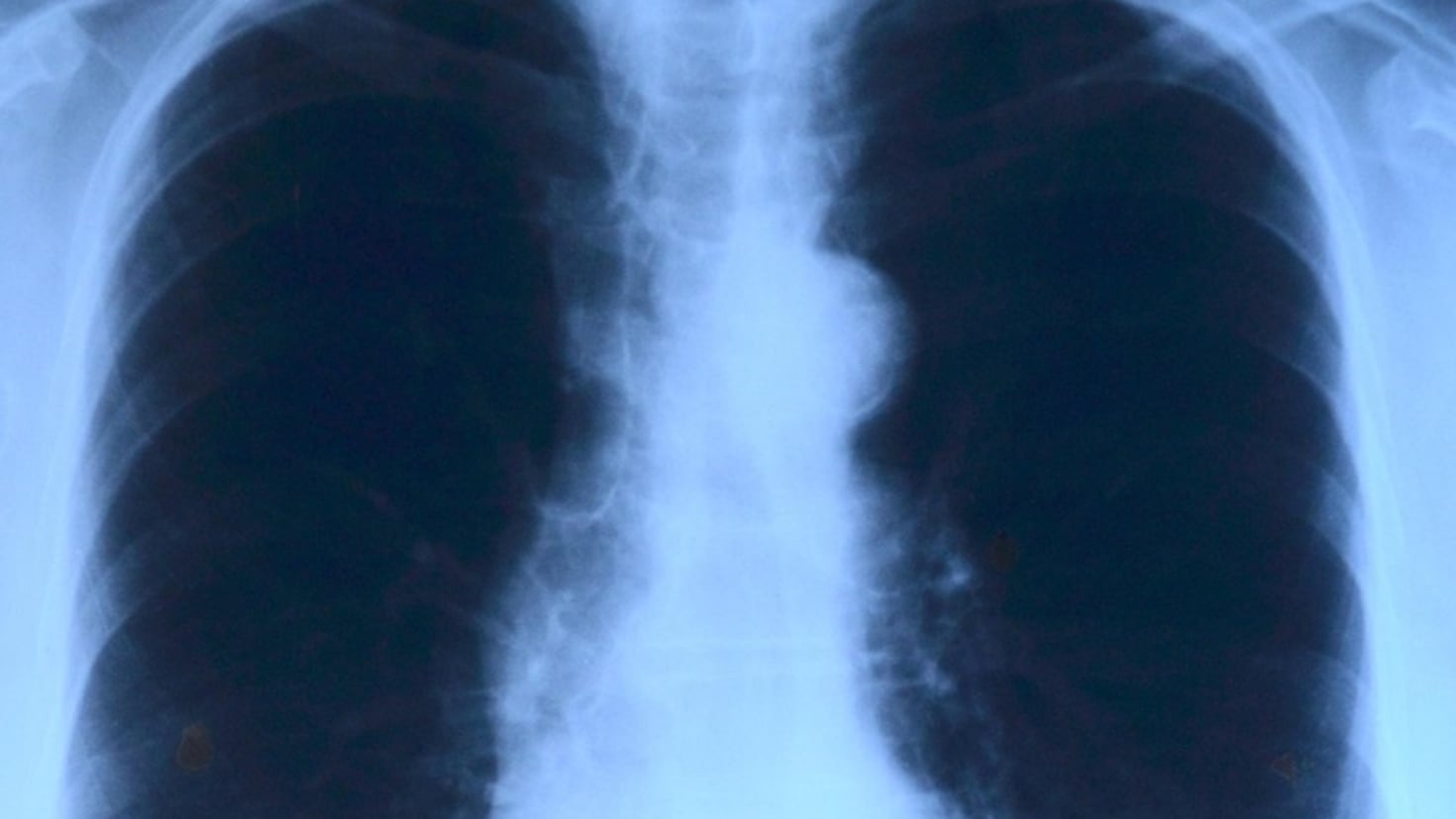 Científicos resuelven una de las causas del cáncer de pulmón más ...