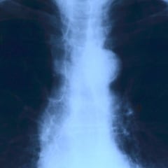 Científicos resuelven una de las causas del cáncer de pulmón más comunes y no tiene nada que ver con el tabaco