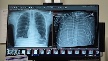 Un hombre vivió 48 horas sin pulmones: un órgano artificial externo lo mantuvo vivo hasta recibir un trasplante