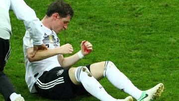 Rudy sufrió una fractura nasal en el partido ante Suecia