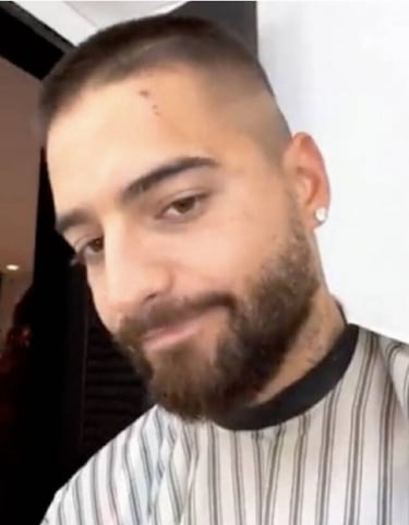 Maluma deja ver sus heridas en la cara tras ser mordido por su perro: Fue de susto