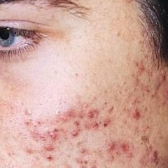 ¿Qué es el maskné?