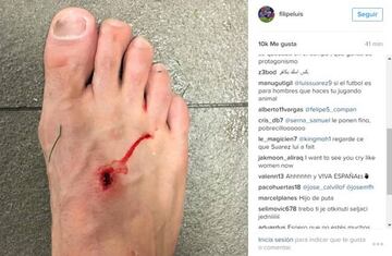 Filipe Luis showed off the wound caused by Luis Suarez´s studs on social media