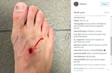 Filipe Luis showed off the wound caused by Luis Suarez´s studs on social media