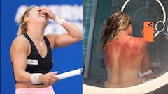 Las quemaduras de Renata Zaraza nos muestran lo extremo del clima en Australia