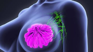 Cómo una IA es capaz de detectar el cáncer de mama tan bien como un radiólogo
