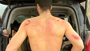 La espalda de Ángel Suárez con heridas de su caída en los test de MTB de su nuevo equipo Commencal 21 en Andorra.
