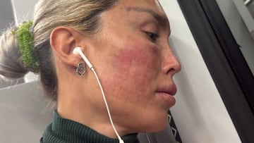 ‘La Pelopony’, sobre su último retoque estético: “Estoy horrorosa”