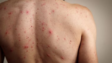 La Secretaría de Salud Federal confirma que México superó los 10 mil contagios de sarampión y acumula 31 fallecidos.