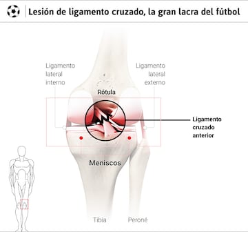 Gráfico que detalla la lesión del ligamento cruzado.