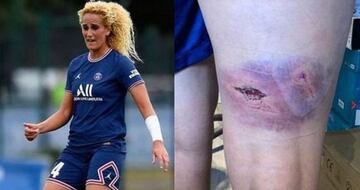 Así quedó la pierna de la futbolista Hamraoui después de ser agredida por dos encapuchados que la golpearon con barras de hierro el pasado mes de noviembre. 