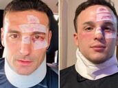 Halloween en Argentina: se disfrazó de Lionel Scaloni ¡después de accidentarse!