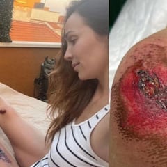 Las impactantes heridas de Nerea Garmendia ocasionadas por la imprudencia de un camionero