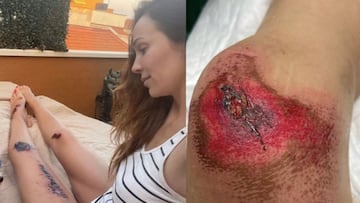 Las impactantes heridas de Nerea Garmendia ocasionadas por la imprudencia de un camionero