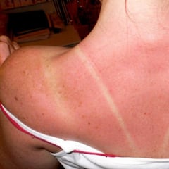 ¿Cuánto dura una quemadura solar y cuánto puede tardar en quitarse?