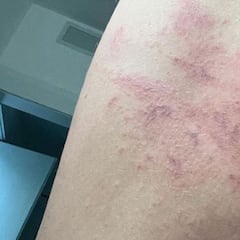 Una "gran medusa" se ceba con Lindsey Vonn mientras surfeaba