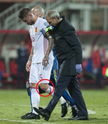 Esguince de grado II en el ligamento colateral medial de la rodilla izquierda.