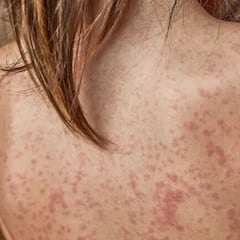 Sarampión en México 2025: ¿cuántos fallecidos y casos positivos hay?