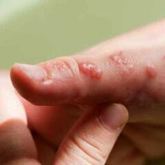 OMS declara emergencia mundial por la viruela del mono: cuántos casos hay en México