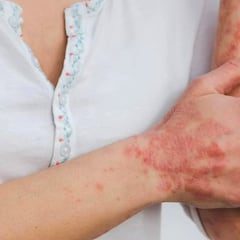 Colima reporta el primer caso de viruela del mono