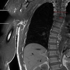 Así está la espalda del 11 veces campeón del mundo de surf