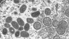 An electron microscopic (EM) image shows mature, oval-shaped monkeypox virus particles as well as crescents and spherical particles of immature virions, obtained from a clinical human skin sample.