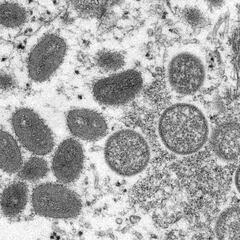 Monkeypox: What is it? Is it deadly? Is it easy to catch?