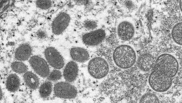 An electron microscopic (EM) image shows mature, oval-shaped monkeypox virus particles as well as crescents and spherical particles of immature virions, obtained from a clinical human skin sample.