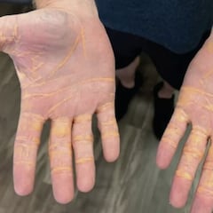 Un hombre se llena de nódulos de colesterol tras practicar una dieta carnívora durante meses: sus niveles llegaron a los 1000 mg/dl