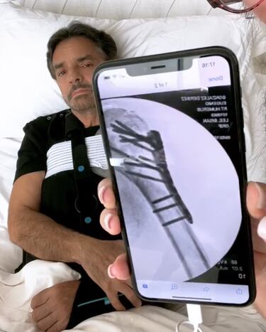 Eugenio Derbez: Qué fue lo que le pasó en el accidente y estado de salud