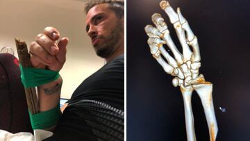 Dovizioso, tras fracturarse la mu?eca.