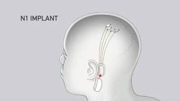 El implante de Neuralink