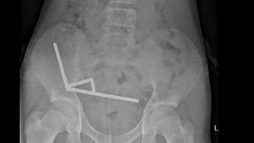 Los cirujanos extraen 100 imanes de los intestinos de un joven de 13 años