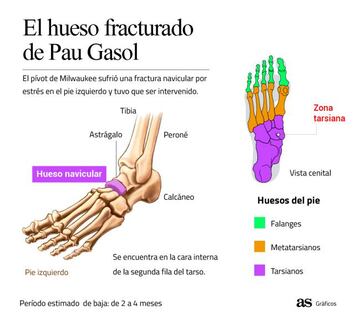 El hueso fracturado de Pau Gasol.