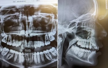 Una madre lleva a su hija al dentista y queda impactada por lo que aparece en la radiografía: “Se le atascó”