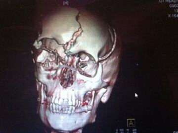 Radiografía del cráneo tras el accidente.