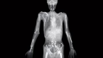 Radiografía atribuida a Travis Pastrana pero que no lo es.