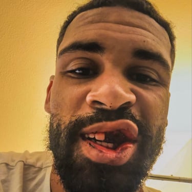 Esta lesión prácticamente pone fin a su temporada con el Milan.