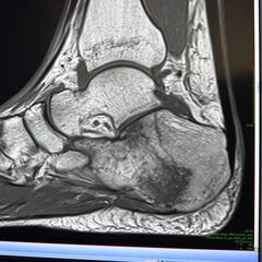 Aleix: “Realmente tengo el pie destrozado”