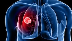 Watch out! Scientists target these vitamins for link to lung cancer