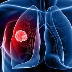 La ciencia pone en el punto de mira una nueva vitamina por su relación con el cáncer de pulmón