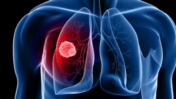 Watch out! Scientists target these vitamins for link to lung cancer