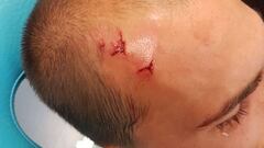 Las heridas en la cabeza del delantero holand&eacute;s del Sporting de Portugal, Bast Dost.