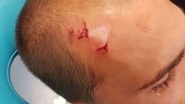 Las heridas en la cabeza del delantero holandés del Sporting de Portugal, Bast Dost.