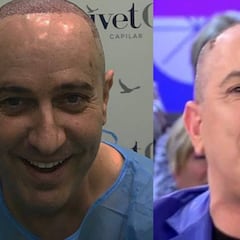 Víctor Sandoval, tras pasar por quirófano: "Soy un monstruo"