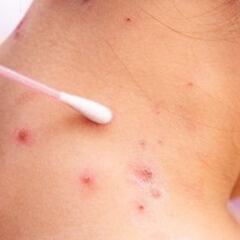 Viruela del mono en Tabasco: cuántos casos se detectaron y cuántos suman en México